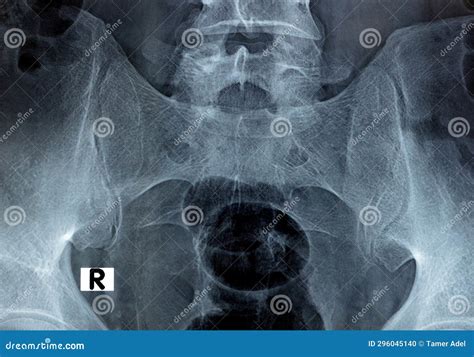 Si Joint Dysfunction X Ray at Karan Katz blog