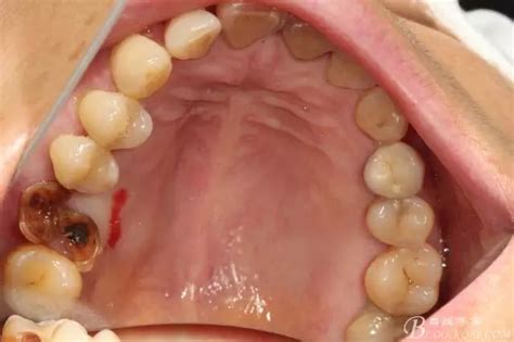 拔牙5天后牙窝愈合过程图图解（拔牙后的”血窟窿”是怎么长好的？了解后再也不用怕拔牙了） | 说明书网