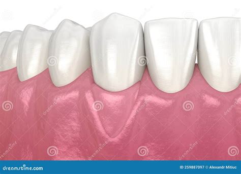 Gum Recession: Soft Tissue Graft Surgery. 3D Illustration of Dental Treatment Stock Illustration ...