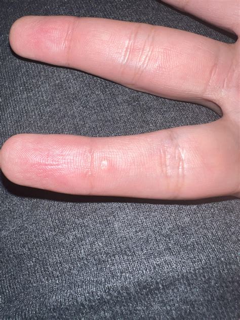 Weird bump on my finger : r/AskDoctorSmeeee