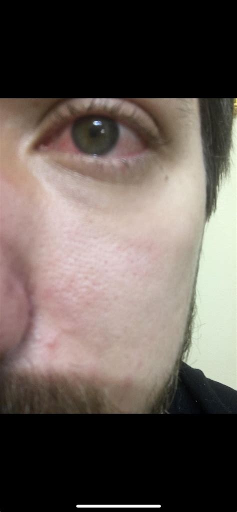 dull ache under left breast : r/DiagnoseMe