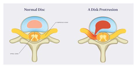 Bulging Disc Surgery 的图像结果