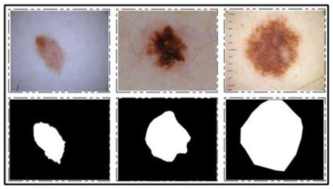 Skin Lesion Segmentation and Multiclass Classification Using Deep ...