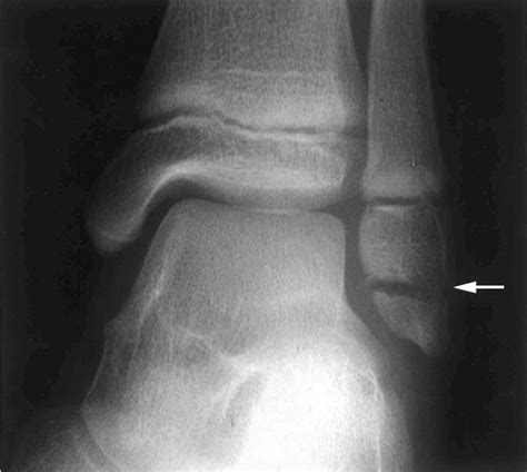 Accessory ossicle or intraepiphyseal fracture of lateral malleolus: are ...