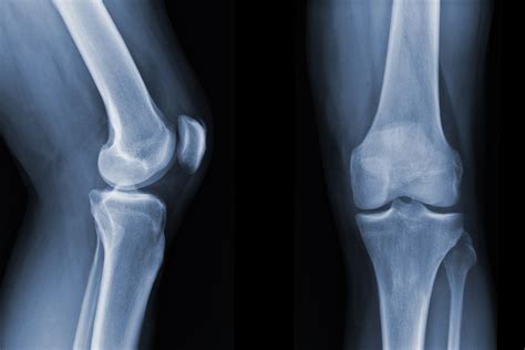 Bad Knee X-Ray Vs. Normal Knee X-Ray | AKPC
