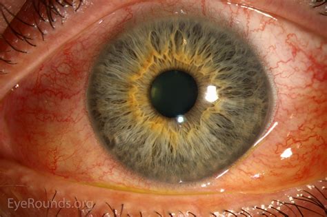 Atlas Entry - Bilateral chemosis in thyroid eye disease