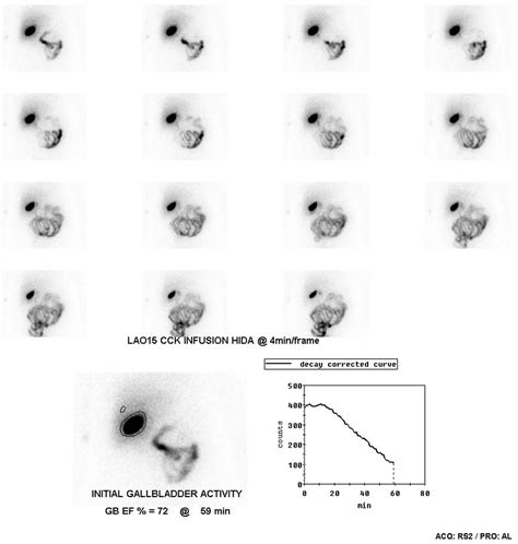 HIDA Scan Procedure - Scan Results, Scan Side Effects