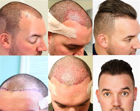 hair transplant washington