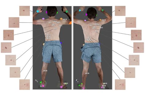Computer Vision for Tumour 的图像结果