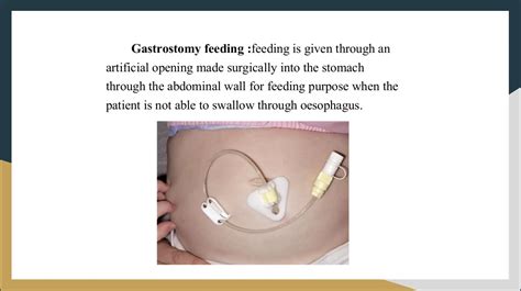 TOPICS TPN (Total Parenteral Nutrition)I Nasogastric Tube Insertion ...