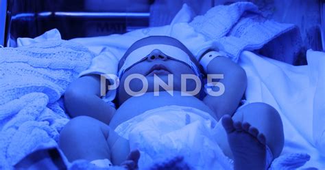 Phototherapy For Jaundice Babies