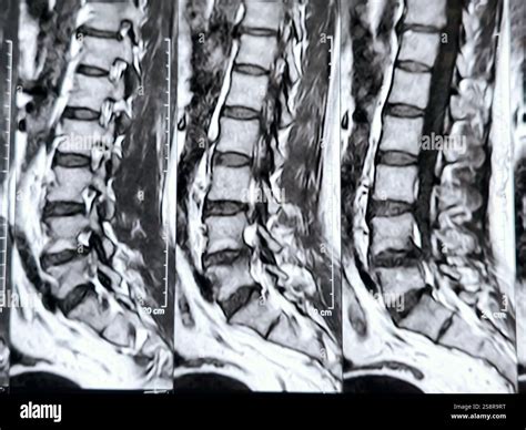 Magnetic Resonance Imaging MRI of the lumbosacral spine shows ...