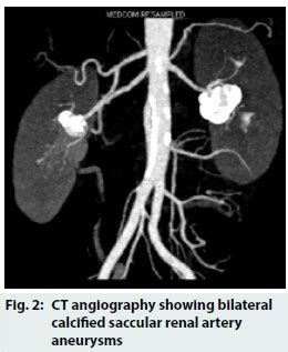 Not every calcification is calculus-A case study
