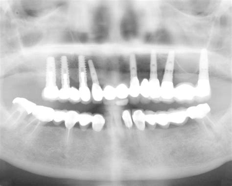 上前牙即刻种植+临时修复-德州种植牙医唐慧的博客-KQ88口腔博客