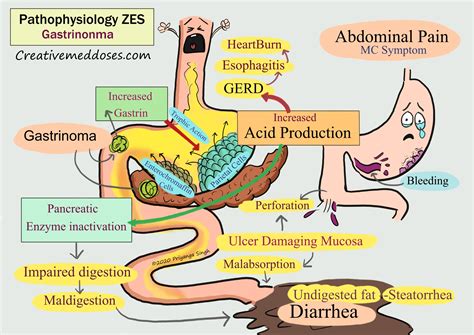 Zollinger-Ellison Syndrome: Symptoms, Causes, And Treatment – IIOMI