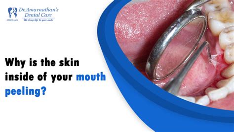 Image result for Exploding Mouth Cyst