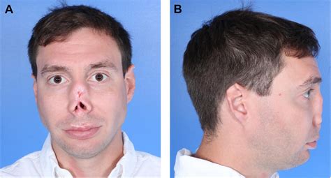 Nasal Lining Reconstruction with Prelaminated Forehead Flap - Facial Plastic Surgery Clinics