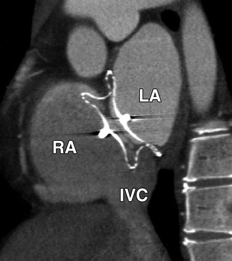 MDCT Evaluation After Closure of Atrial Septal Defect with an Amplatzer Septal Occluder | AJR
