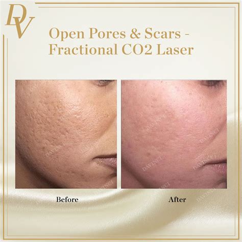 Fractional CO2 Laser Skin Resurfacing Malaysia