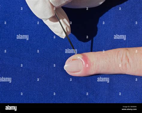 Infected Abscess Lanced 的图像结果