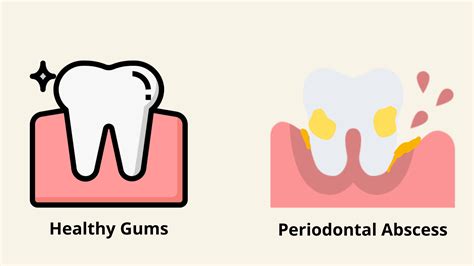 The stages of a gum abscess and its healing process