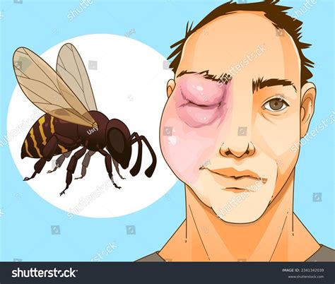 Bee Sting Swollen And Itchy