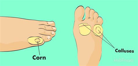 How To Treat A Corn On A Toe at Norma Benoit blog