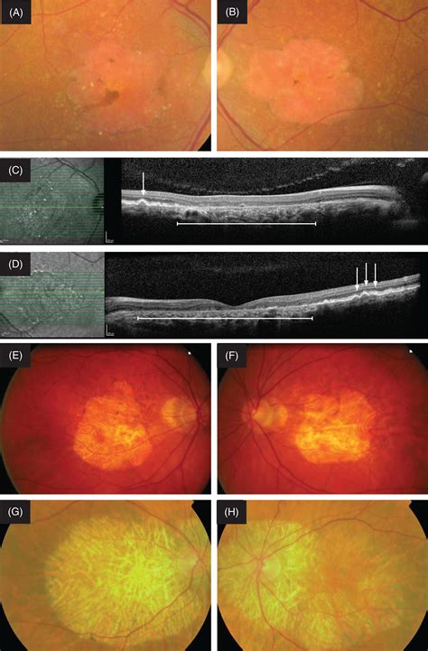 Genetic screening for macular dystrophies in patients clinically diagnosed with dry age‐related ...