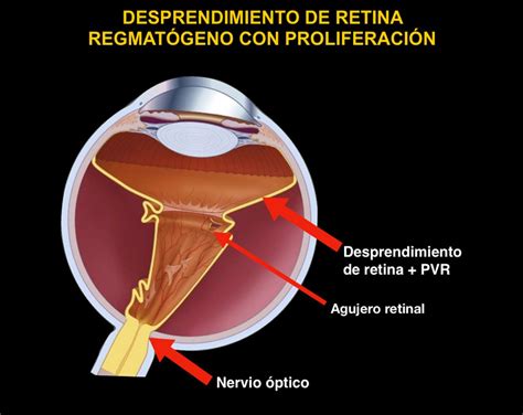 Desprendimiento de Retina | Somos Retina y Mácula Consultores