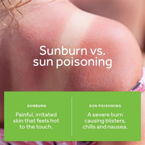 Sun Poisoning Vs Sunburn