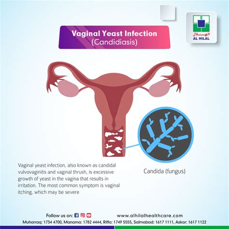 Can Heat Cause Yeast Infection at Lynda Higgins blog