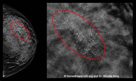 What Do I Need to Know About Mammograms and Dense Breasts? Archives | DenseBreast-info, Inc.