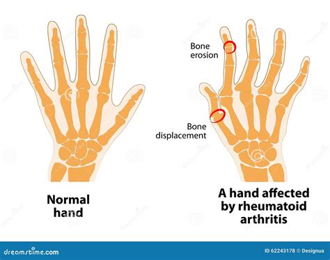 Normale Hand Und Rheumatoide Arthritis Vektor Abbildung - Illustration von abbildung, krankheit ...
