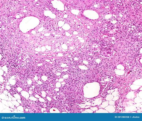 Breast. Fat necrosis stock photo. Image of female, pathology - 281280358