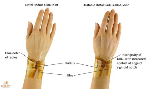 Radius Bone