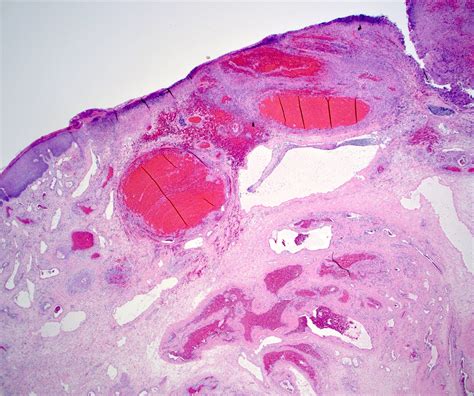 Thrombosed Hemorrhoid Histology