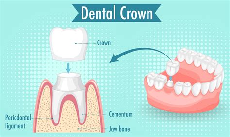 What is a Dental Crown? Types, Procedures & Benefits Explained
