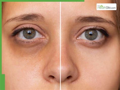 Natural benefits of applying ghee under the eyes: How this remedy works