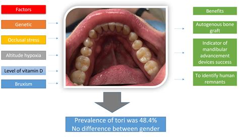 Unilateral Torus Mandibularis