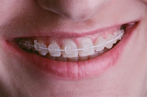Clear Ceramic Braces