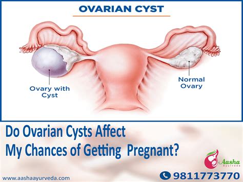 Ovarian cysts 101 causes signs treatment myths – Artofit