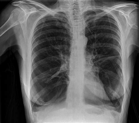 Shortening Expiration at Miles Gomez blog