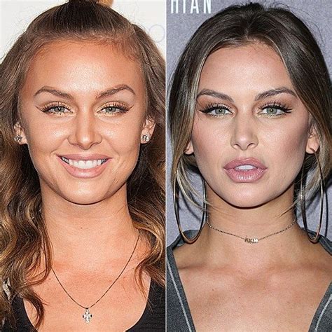 Bildergebnis für lip+fillers+for+celebrities