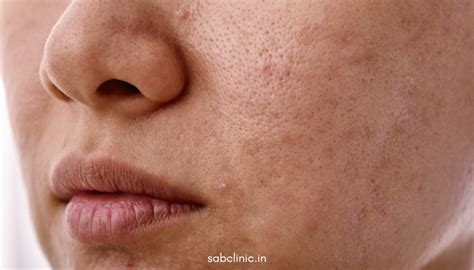 Best Dermatologist in Delhi | Skin Aura Brain