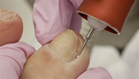 10 Self-care Measures to Manage Your Ingrown Toenail at Home ...