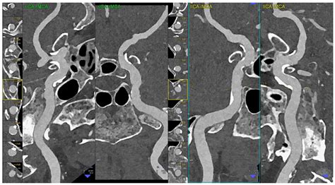 Photon-Counting Computed Tomography Angiography of Carotid Arteries: A ...
