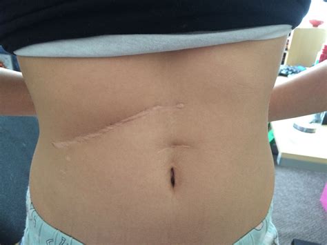 Liver Transplant Scar