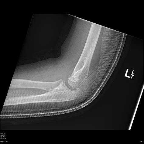 Elbow Olecranon Fractures Orthoinfo Aaos