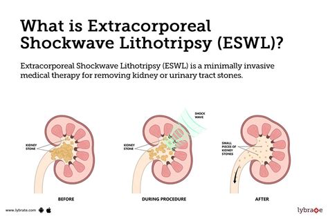 Lithotripsy Procedure 的图像结果