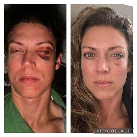 Karly Almon | CSCS TSAC-F | Grade 3 concussion, broken distal fibula ...